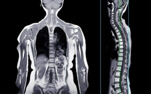 La vérité troublante derrière la première mort attribuée à une allergie à la viande provoquée par une piqûre de tique