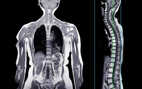 La vérité troublante derrière la première mort attribuée à une allergie à la viande provoquée par une piqûre de tique
