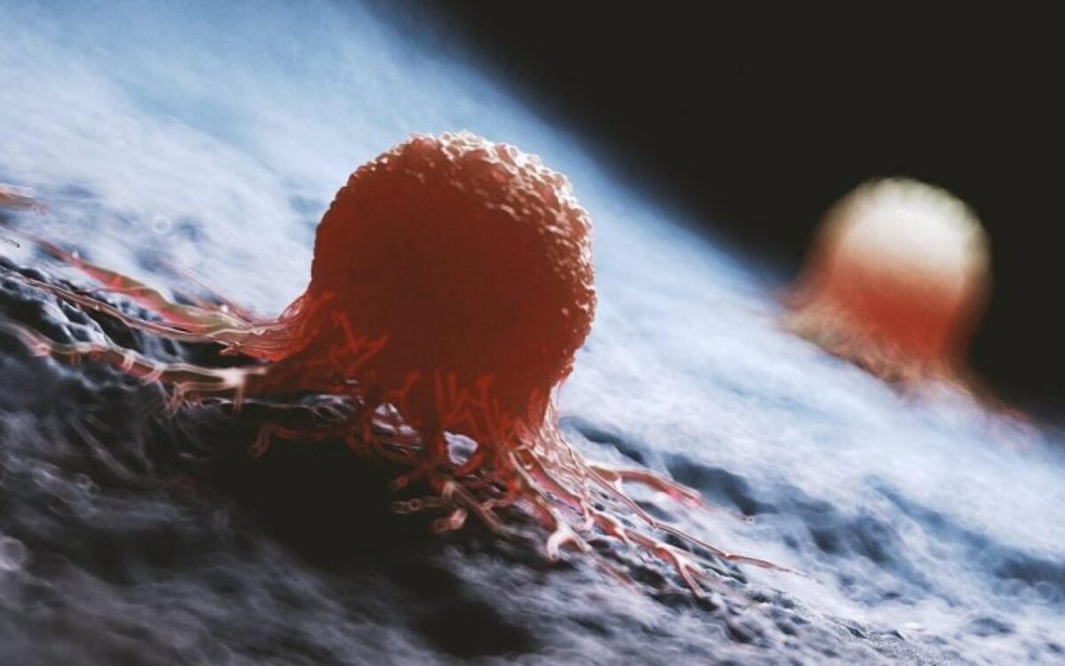 Le mystère du cancer colorectal : pourquoi des jeunes sont touchés de plus en plus tôt