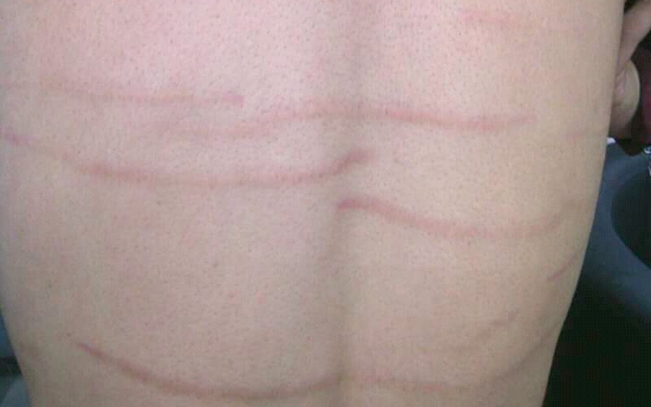 +35%, cas en hausse chez les Asiatiques-Américaines, risque accru avant 40 ans, ce signal inattendu inquiète les médecins
